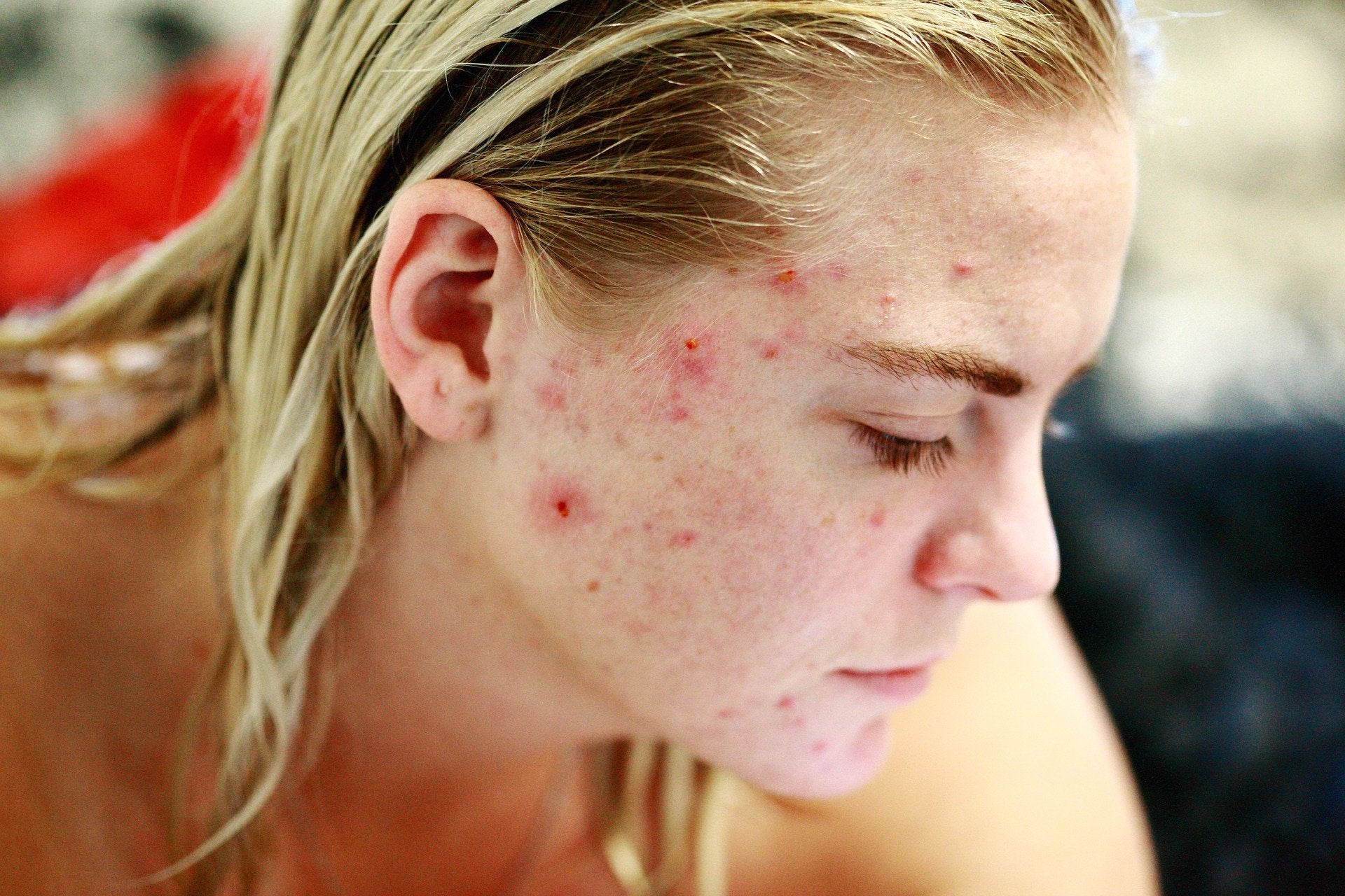 Ways To End Pimples Naturally At Home